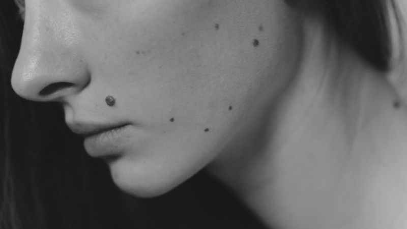Benign Moles Removal FAQs Harrogate Harrogate