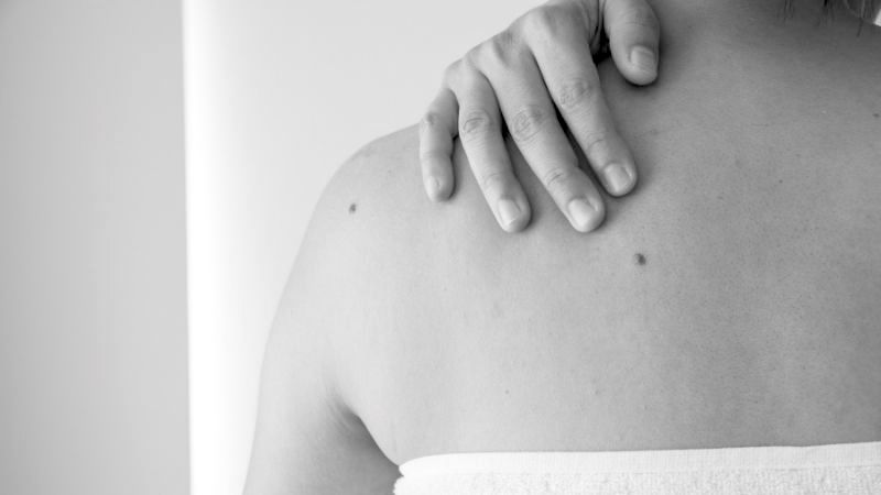 Who Is Suitable for Benign Mole Removal Harrogate? Harrogate