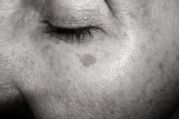 Age Spots Removal in Harrogate&ndash; Clear, Even-Looking Skin at Home Harrogate