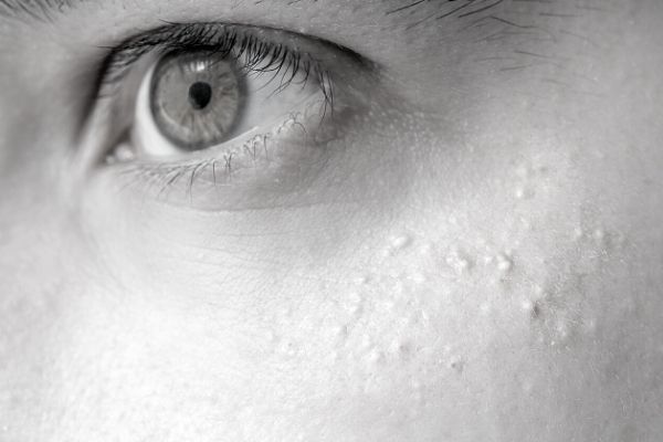 Aftercare Advice Following Milia Removal Harrogate Harrogate