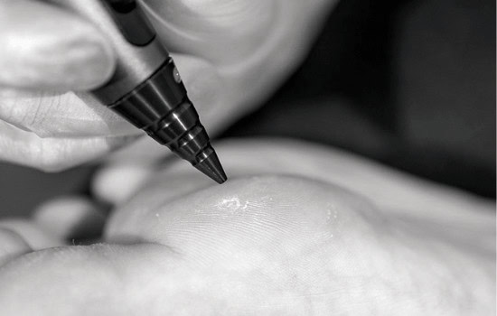 Warts Aftercare Advice for Faster Healing Harrogate