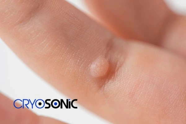 Contact Cryosonic today to learn more about us Harrogate now! Harrogate