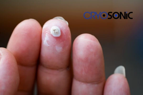 Learn more about us Harrogate at Cryosonic. Book in today! Harrogate