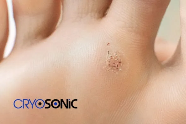 Book in your Verrucae removal treatment today Harrogate Harrogate