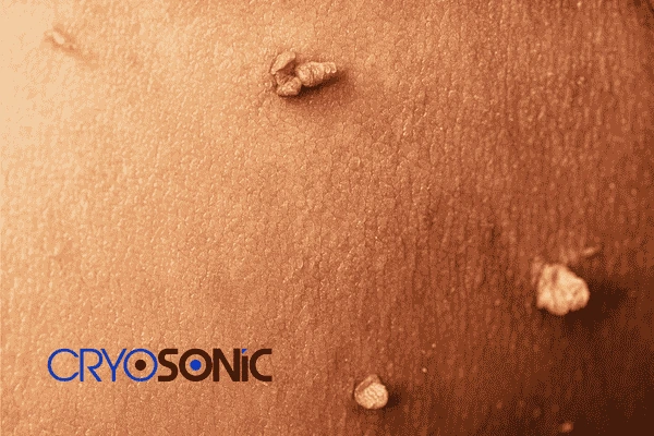 Do you want to get skin tags removal Harrogate? Contact our team today! Harrogate