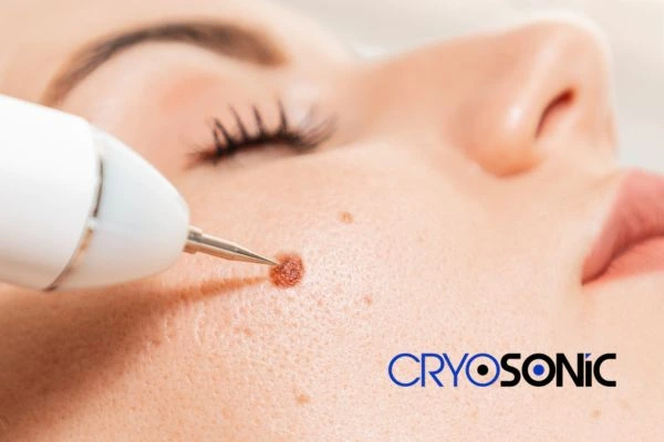 why choose us at Cryosonic for blemish removal? Find out more now Harrogate