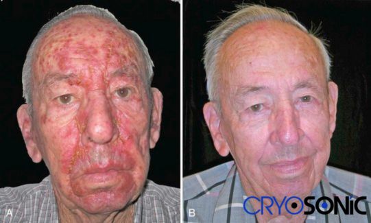 Actinic Keratosis Treatment before and after results Harrogate Harrogate