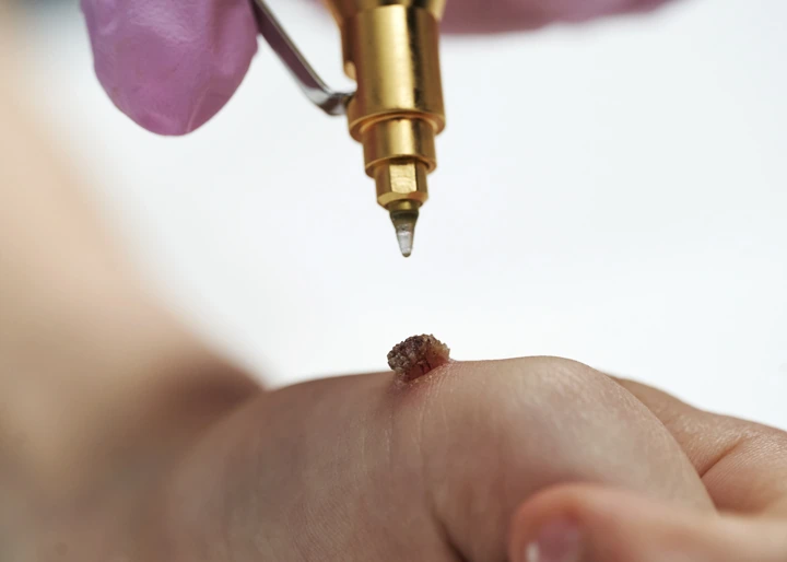 Cryopen For Children Bristol Harrogate