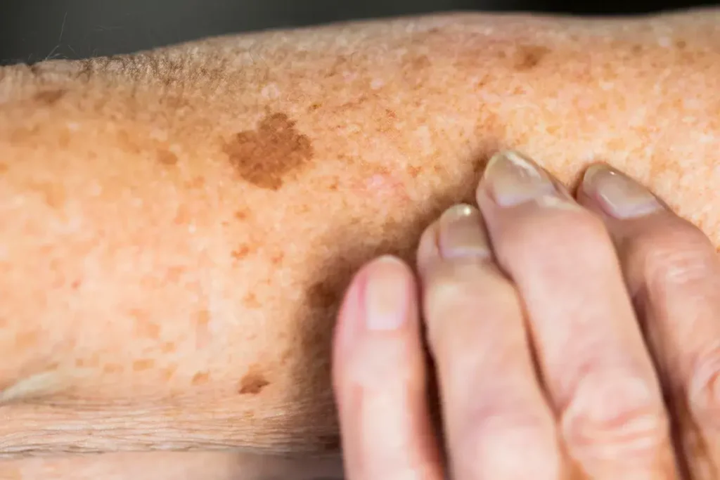 Sun Damage Aftercare and Skin Recovery Harrogate
