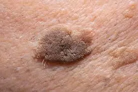 Recovery and Aftercare Advice after Seborrhoeic Keratosis Harrogate