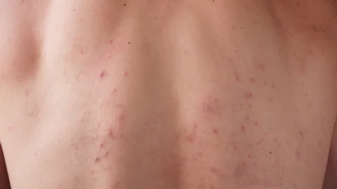 Molluscum Contagiosum Aftercare Advice for Faster Healing Harrogate