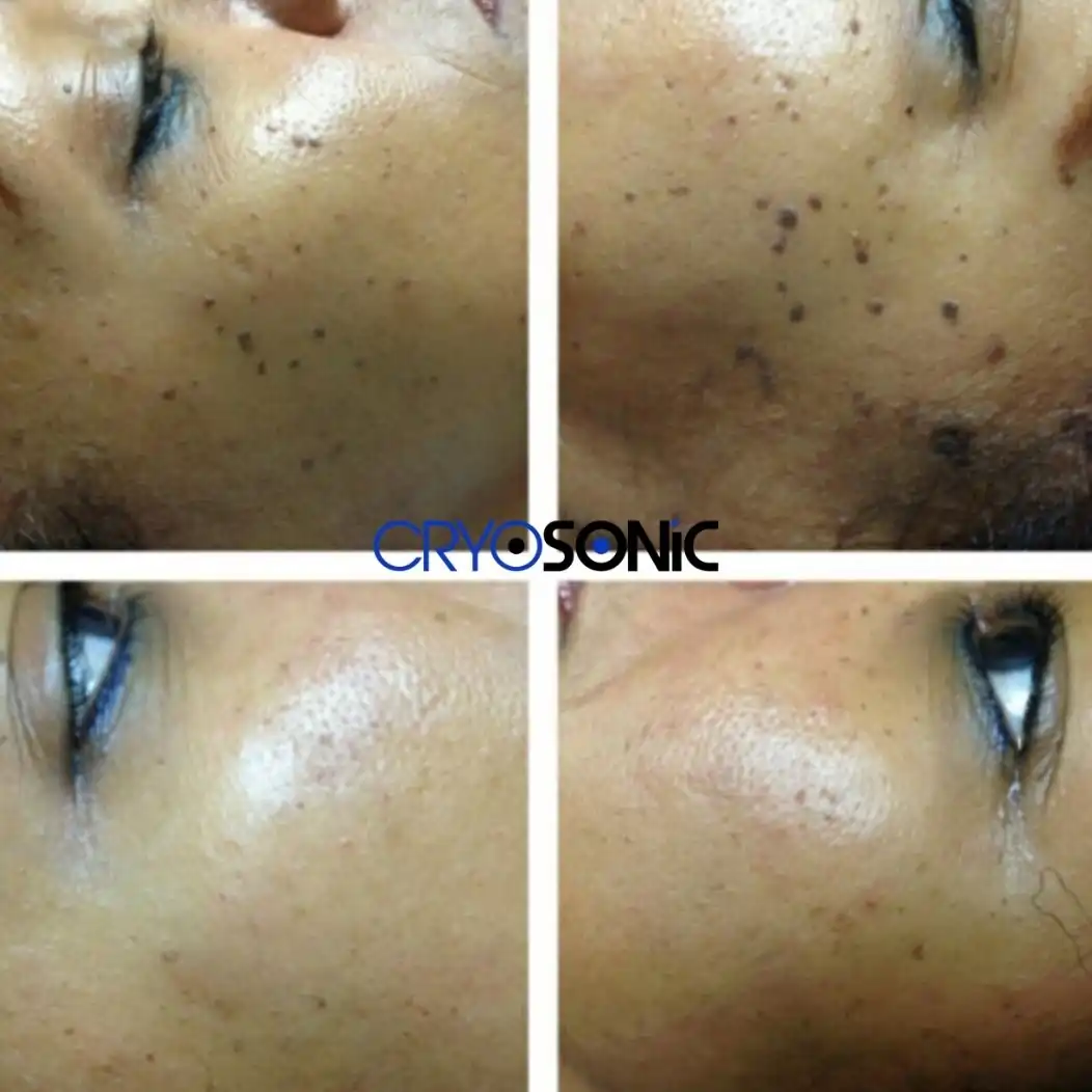 Why Skin Shows Pigmentation After Treatment Harrogate