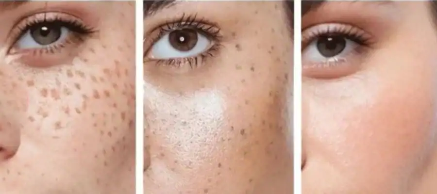 Ephelides Removal Results and Healing Timeline Harrogate