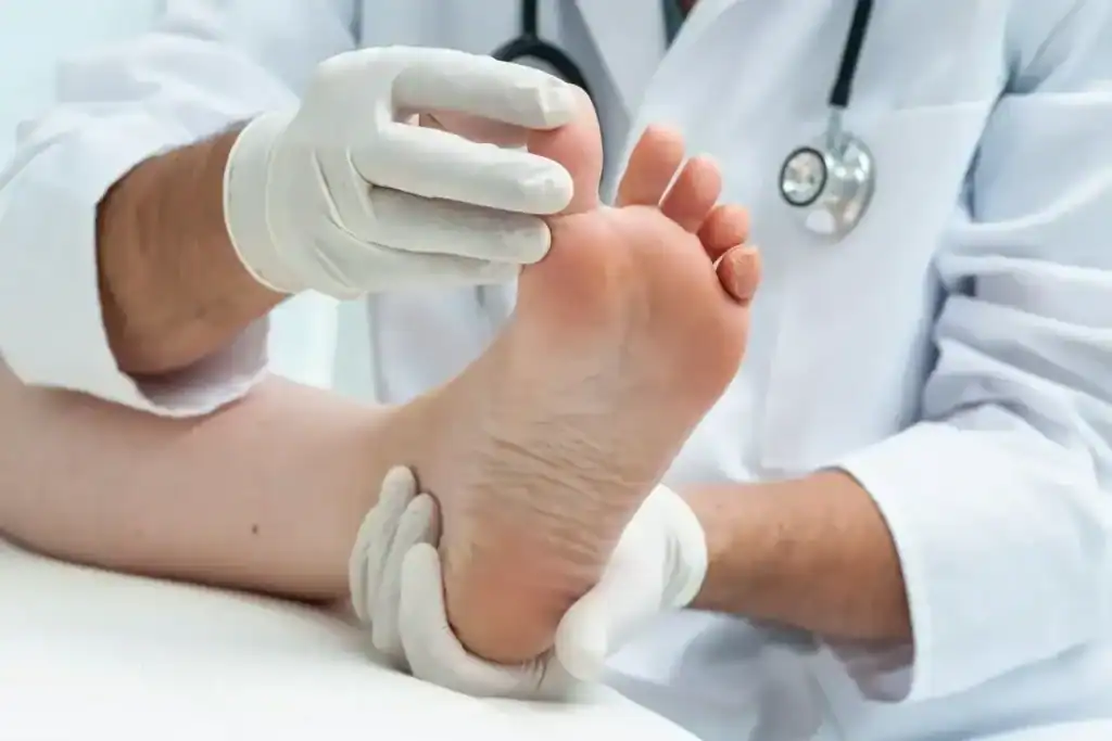Porokeratosis Removal Treatment Harrogate