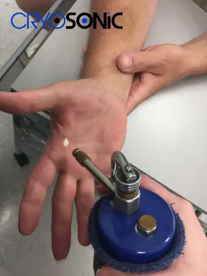 Temperature Differences: OTC vs Medical-Grade Cryotherapy Harrogate